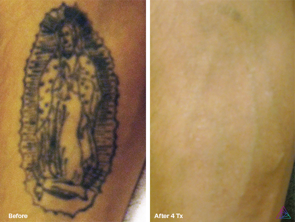 Before and after tattoo removal